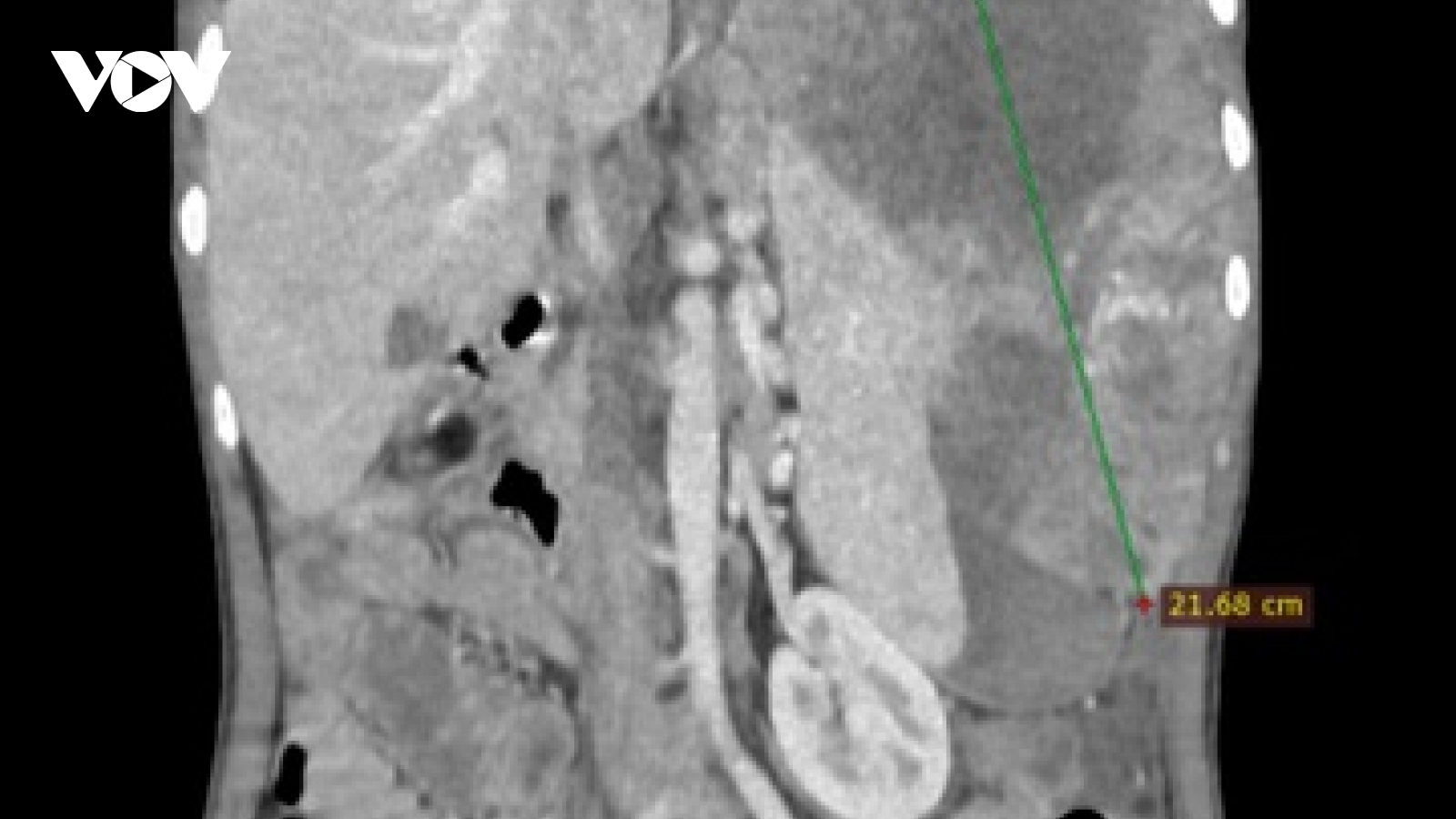 Ung thư gan: Sát thủ thầm lặng với tỷ lệ tử vong cao